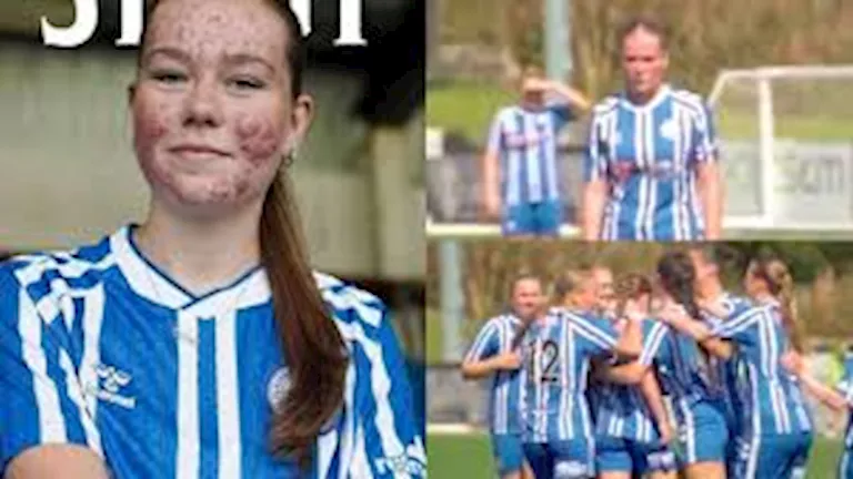 لاعبة تواجه تنمراً قاسياً بسبب "حب الشباب" وتحظى بدعم رياضي وسياسي