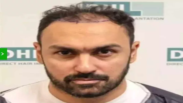 نجوم كرة القدم يشاركون صورهم قبل وبعد زراعة الشعر بشكل مثير للإعجاب